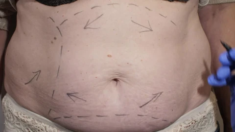Stock Video Marking Abdomen Before Liposuction Surger Animated Wallpaper - Free Live Wallpaper