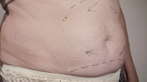 Stock Video Marking A Womans Abdomen Before Liposuctio Animated Wallpaper - Free Live Wallpaper