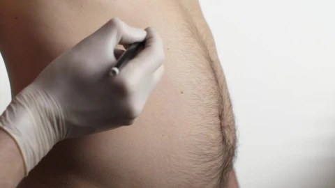 Stock Video Marking A Mans Abdomen Before Liposuction Surger Animated Wallpaper - Free Live Wallpaper