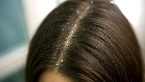 Free Stock Video Woman With Dandruff In Hair Close Up Live Wallpaper - Free Live Wallpaper