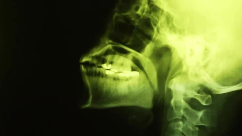 Stock Footage X Ray Of Bone Mass Of The Head Live Wallpaper Free - Free Live Wallpaper
